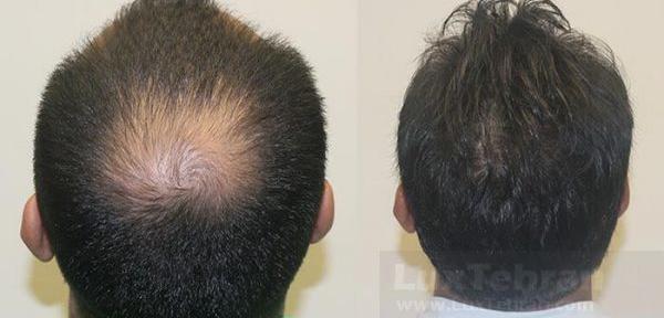 عکس کاشت مو وسط سر