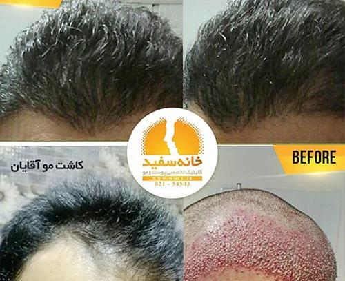 عکس کاشت مو وسط سر