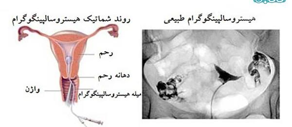 عکس طبیعی داخل رحم