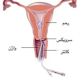 عکس طبیعی داخل رحم