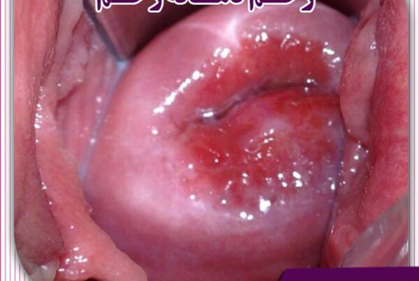 عکس طبیعی داخل رحم