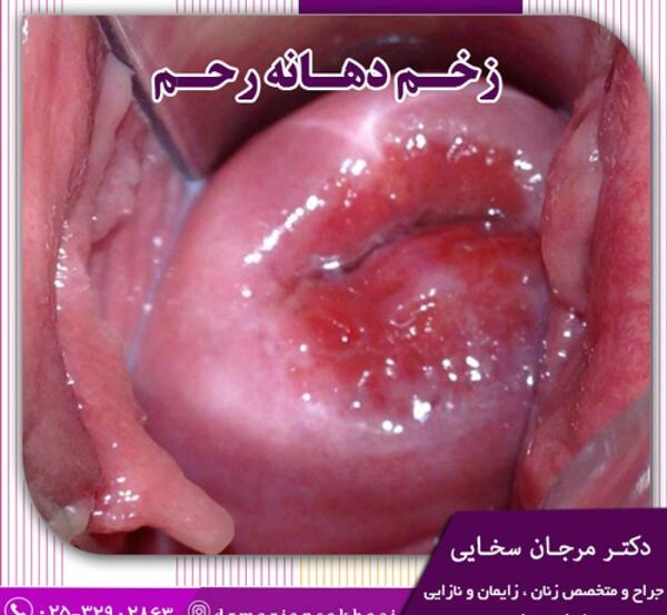 عکس طبیعی داخل رحم
