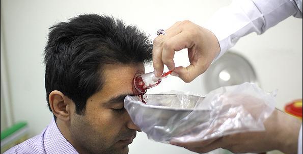 عکس حجامت ریه