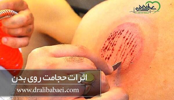 عکس حجامت ریه