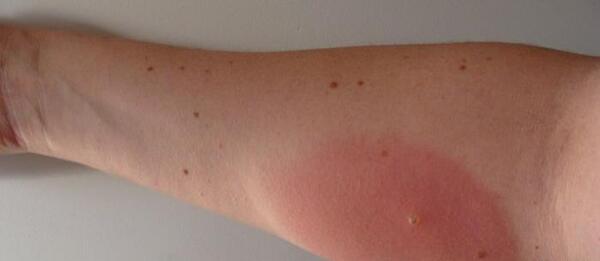 عکس سوسک گزیدگی