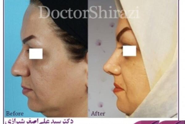 عکس وی تی گوش