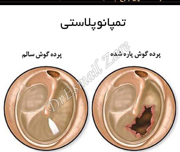 عکس وی تی گوش