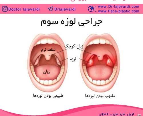 عکس وی تی گوش