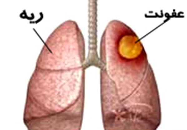 عکس ریه برای چیست