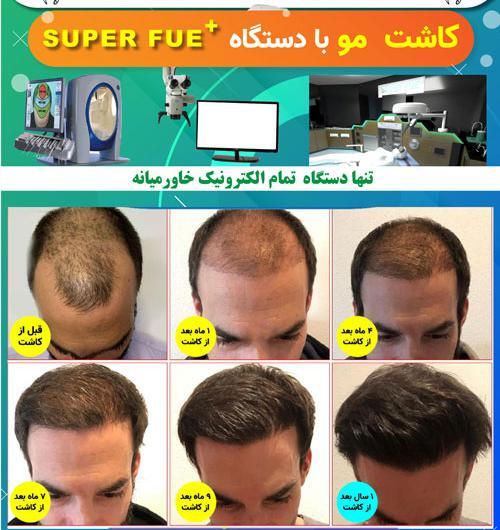 عکس کاشت مو بعد از 4 ماه