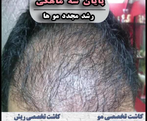 عکس کاشت مو بعد از 4 ماه