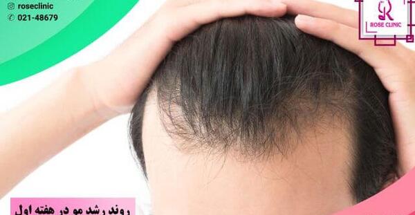 عکس کاشت مو بعد از 4 ماه
