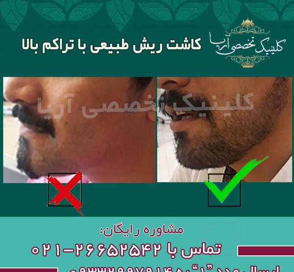 عکسهای کاشت ریش