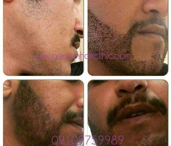 عکسهای کاشت ریش