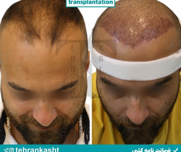 عکسهای کاشت ریش