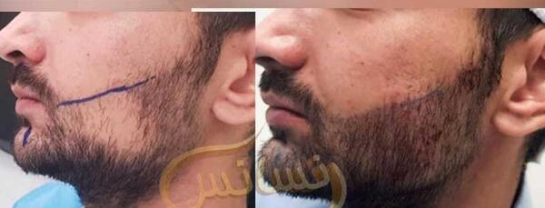 عکسهای کاشت ریش