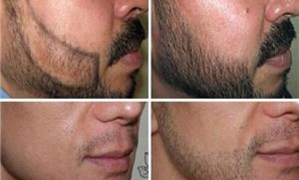 عکسهای کاشت ریش