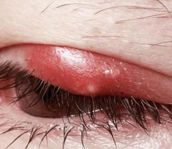 عکس شپش مژه