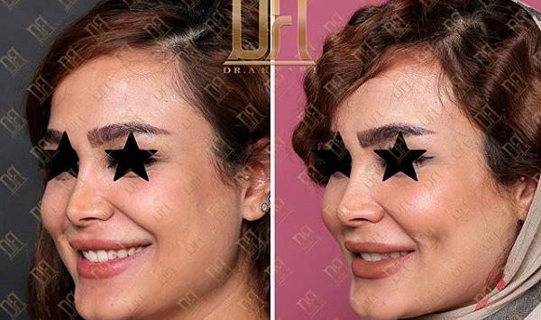 عکس کاشت چال لپ