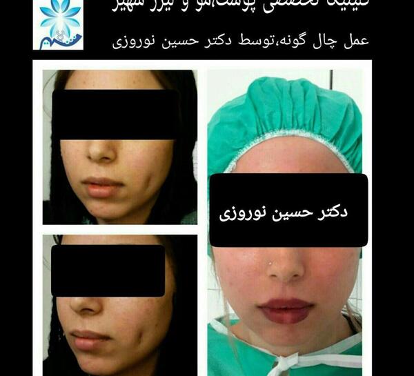 عکس کاشت چال لپ