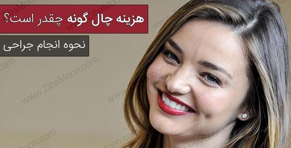 عکس کاشت چال لپ