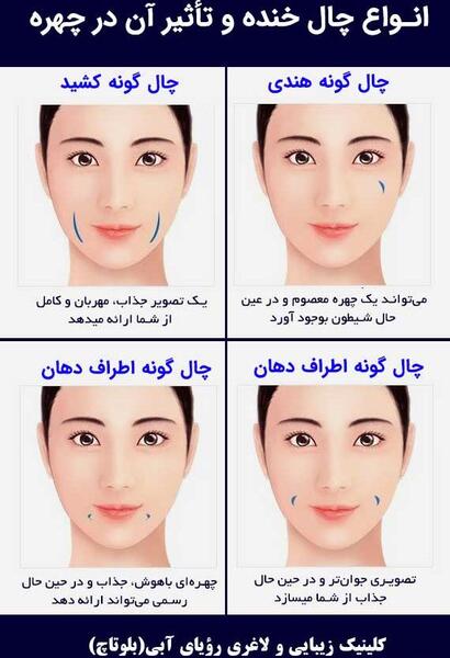 عکس کاشت چال لپ
