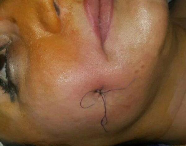 عکس کاشت چال لپ