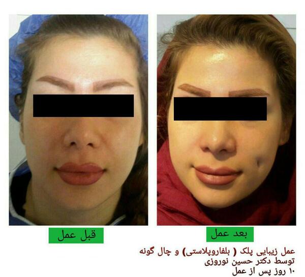 عکس کاشت چال لپ