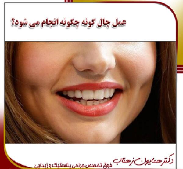 عکس کاشت چال لپ