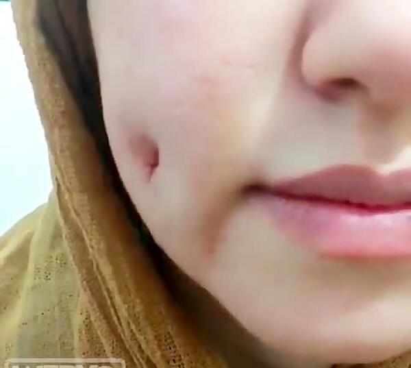 عکس کاشت چال لپ