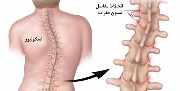 عکس واقعی ستون فقرات