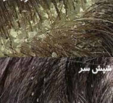 عکس شپش تو سر