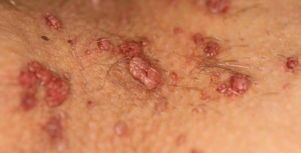 عکس شپش ناحیه ی تناسلی