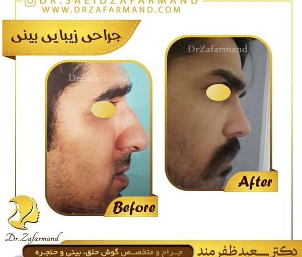 عکس داخل بینی سالم