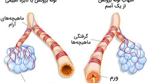 عکس ریه آسمی