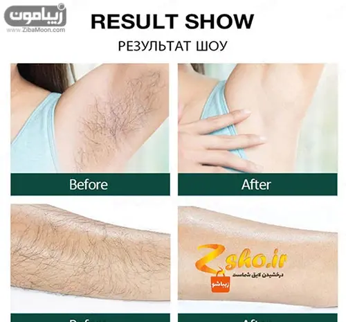 عکس دستگاه لیزر مو زائد