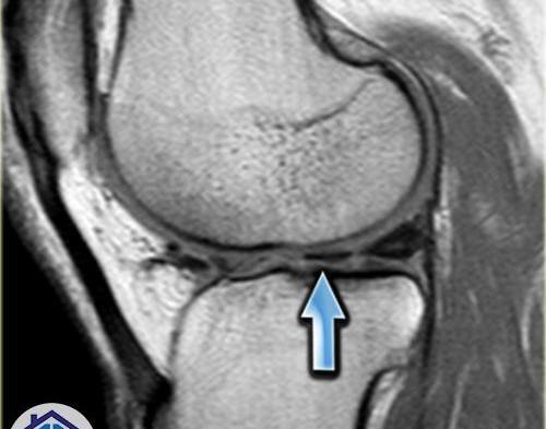عکس ام ار ای پارگی مینیسک زانو