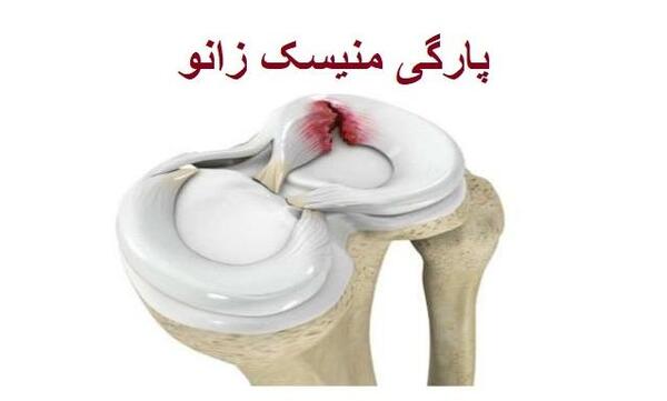 عکس ام ار ای پارگی مینیسک زانو