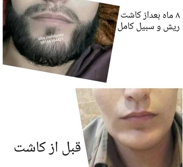 عکس کاشت صورت