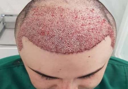 عکس کاشت صورت