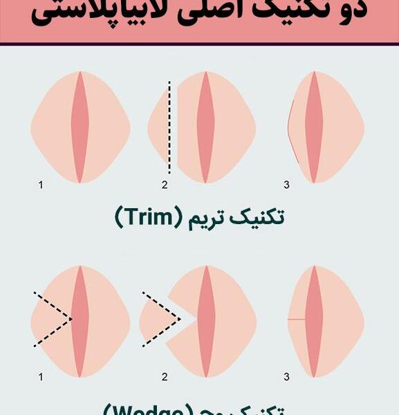 لابیاپلاستی عکس واقعی