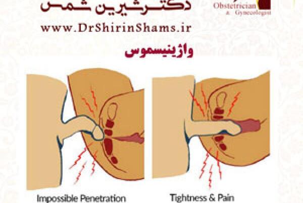 لابیاپلاستی عکس واقعی