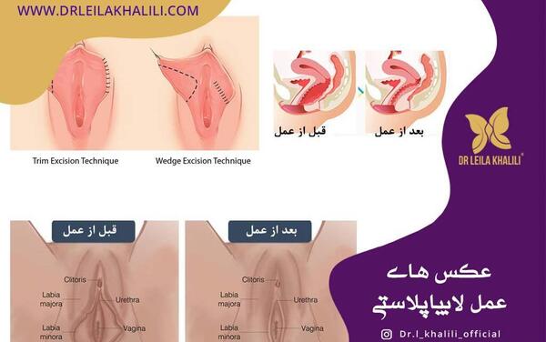 لابیاپلاستی عکس واقعی