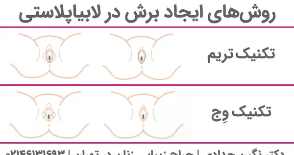 لابیاپلاستی عکس واقعی
