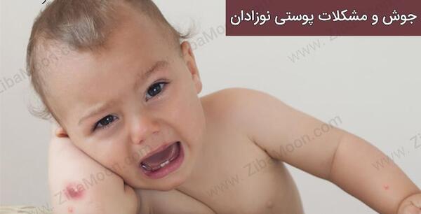 عکس جوش صورت نوزاد