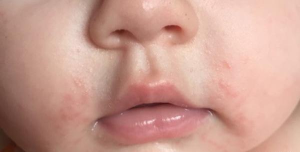 عکس جوش صورت نوزاد