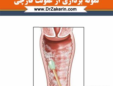 عکس عفونت داخل واژن