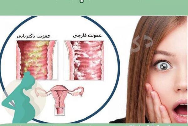 عکس عفونت داخل واژن