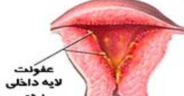 عکس عفونت داخل واژن