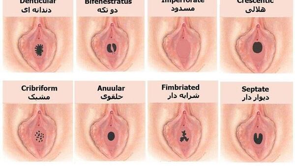 عکس عفونت داخل واژن